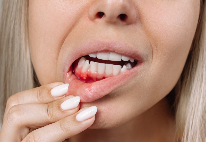 A woman with sore gums & white teeth, promoting emergency dental care in Charles Town, WV.