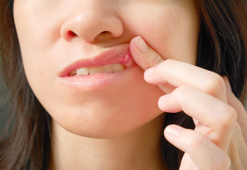 A close-up of a canker sore on the inner lip, highlighting ways to clear it up in Charles Town, WV