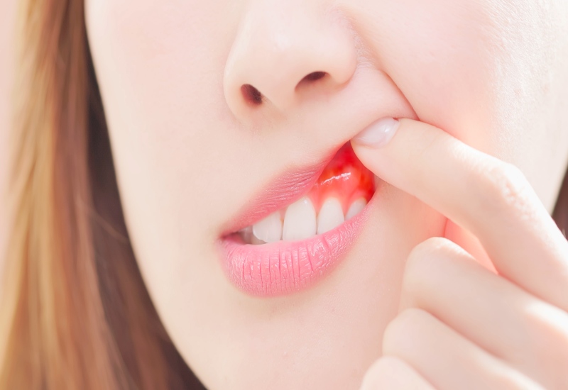 A close-up of bleeding gum showcasing periodontal disease in a clinic in Charles Town, WV