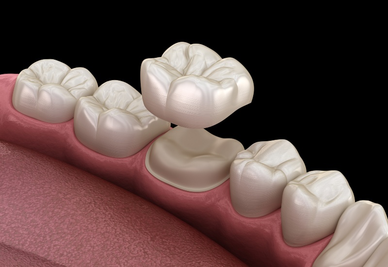 A 3D rendering of zirconia dental crown placement on the molar in Charles Town, WV