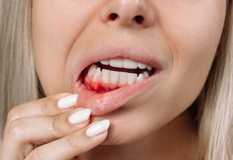 Close-up of inflamed gums with lesions, highlighting bleeding gums issue in Charles Town, WV