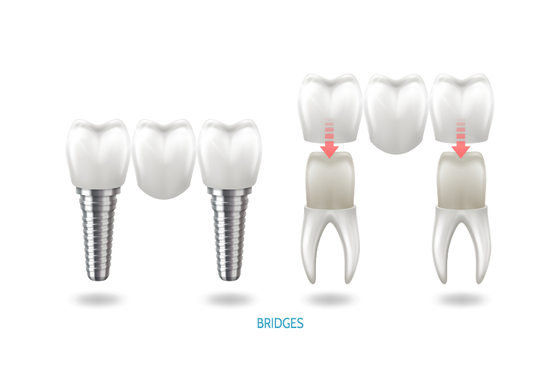 Dental implant-supported vs. tooth-supported bridge comparison in Charles Town, WV